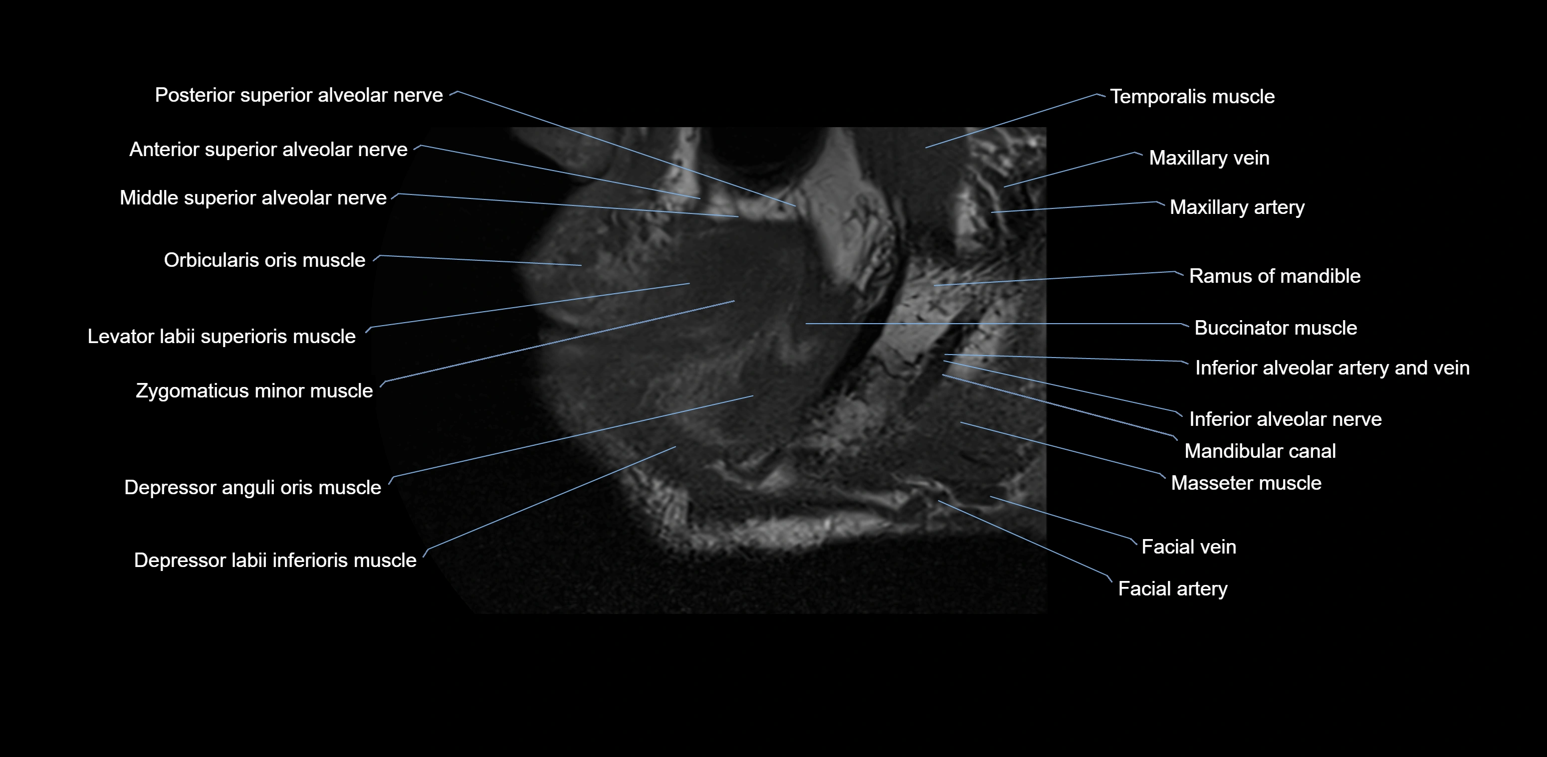 Dental MRI( tooth) sagittal labelled  cross sectional 3T anatomy -img-00001-00002.webp